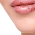 Stress Management for Reducing Herpes Outbreaks