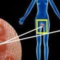 Understanding the Risks of Untreated Genital Herpes