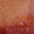 Oral Herpes Treatment: An Overview of Oral Medications