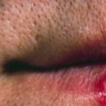 Complications of Untreated Oral Herpes