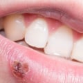 Vision Problems in Rare Cases: Understanding Risks of Untreated Oral Herpes