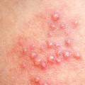 Painful Blisters or Sores on the Genitals or Rectum