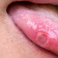 Reducing the Risk of Transmitting Oral Herpes
