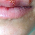 Complications of Oral Herpes Infection