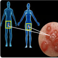 Diagnosing Genital Herpes: Viral Culture Tests Explained