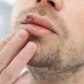 Testing for Oral Herpes Infection