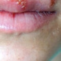 Cold Sores or Blisters Around the Mouth and Nose