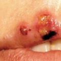 Oral Corticosteroids for Oral Herpes