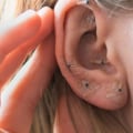 Acupuncture for Herpes Treatment