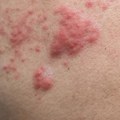 Understanding Burning and Itching Sensations Related to Genital Herpes
