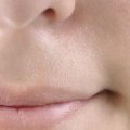 Painful Blisters or Sores