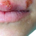 Testing for Oral Herpes: A Comprehensive Overview