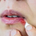 Topical Treatments for Herpes Relief