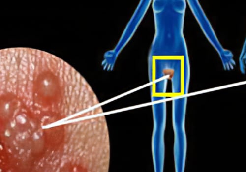 Reducing the Risk of Transmitting Genital Herpes