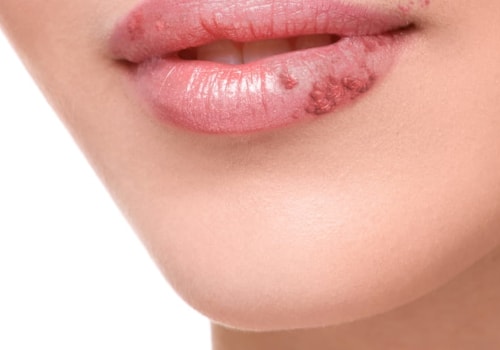Stress Management for Reducing Herpes Outbreaks