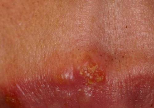 Oral Herpes Treatment: An Overview of Oral Medications