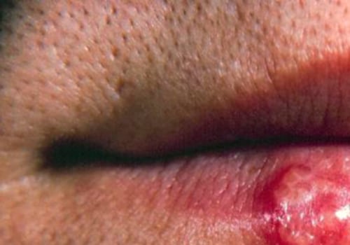 Complications of Untreated Oral Herpes
