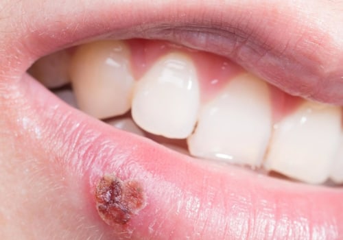 Vision Problems in Rare Cases: Understanding Risks of Untreated Oral Herpes