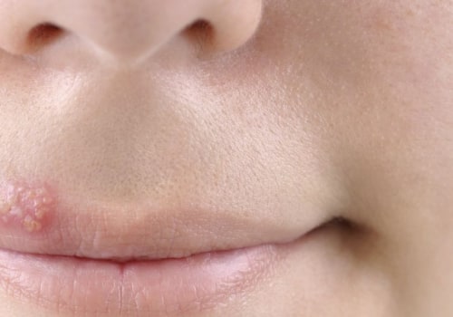 Understanding Oral Medications for Oral Herpes