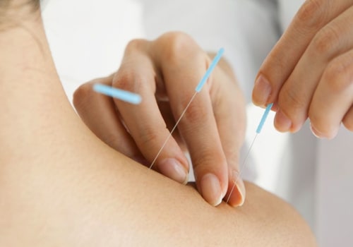 The Benefits of Acupuncture: An Alternative Therapy for Herpes Remedies