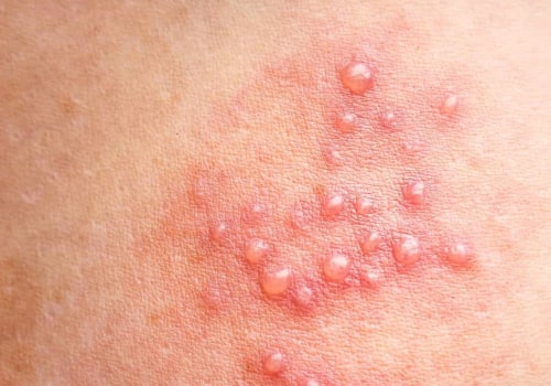 Painful Blisters or Sores on the Genitals or Rectum