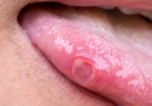 Reducing the Risk of Transmitting Oral Herpes