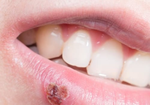 Understanding Recurring Outbreaks of Oral Herpes