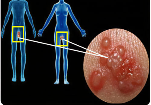 Diagnosing Genital Herpes: Viral Culture Tests Explained
