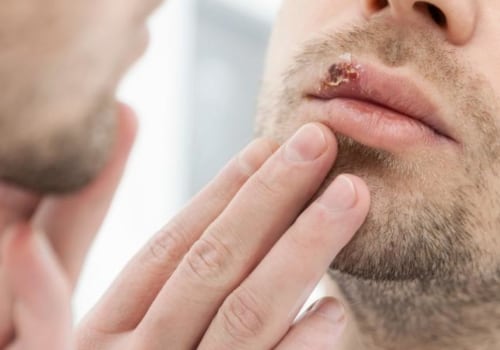 Testing for Oral Herpes Infection