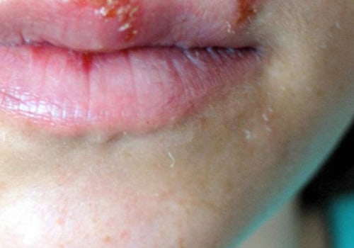 The Facts about Cold Sores Around the Mouth and Nose