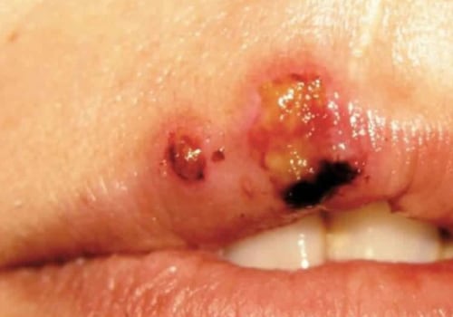 Oral Corticosteroids for Oral Herpes