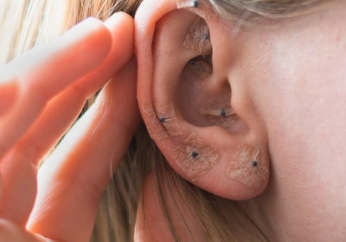 Acupuncture for Herpes Treatment