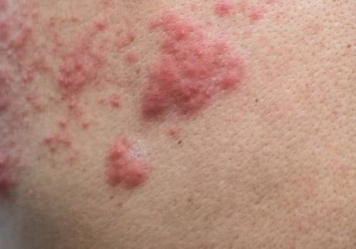 Understanding Burning and Itching Sensations Related to Genital Herpes