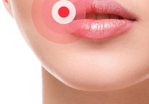 Topical Creams and Ointments for Genital Herpes