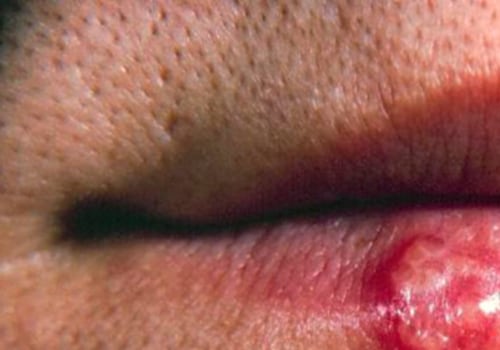 Untreated Genital Herpes: Complications and Prevention