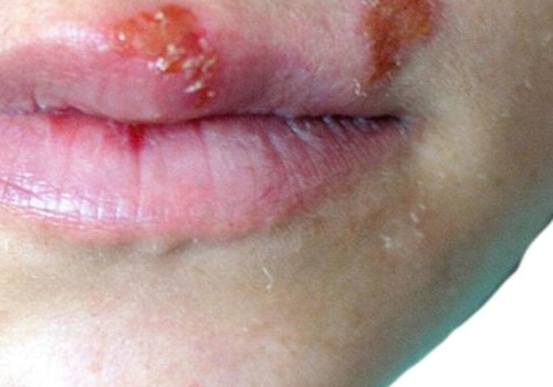 Testing for Oral Herpes: A Comprehensive Overview