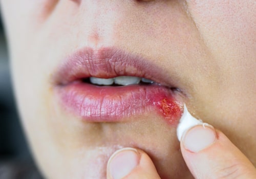 Topical Treatments for Herpes Relief