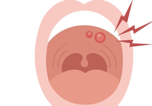 Avoiding Contact With Sores: An Overview